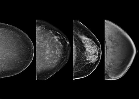 the villages breast cancer mammogram images|PHOTO GALLERY: What does breast cancer look like on .